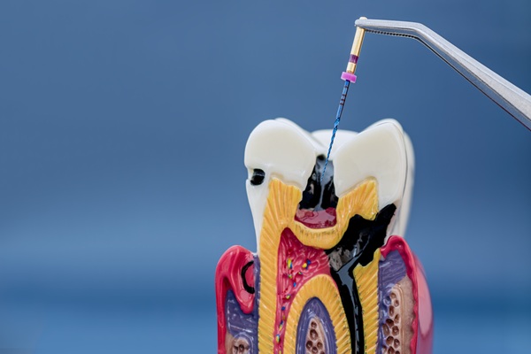 Endodontics Treatment For Tooth Pain